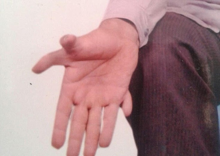 Ο άνθρωπος με τα περισσότερα δάχτυλα στον κόσμο - Εικόνα