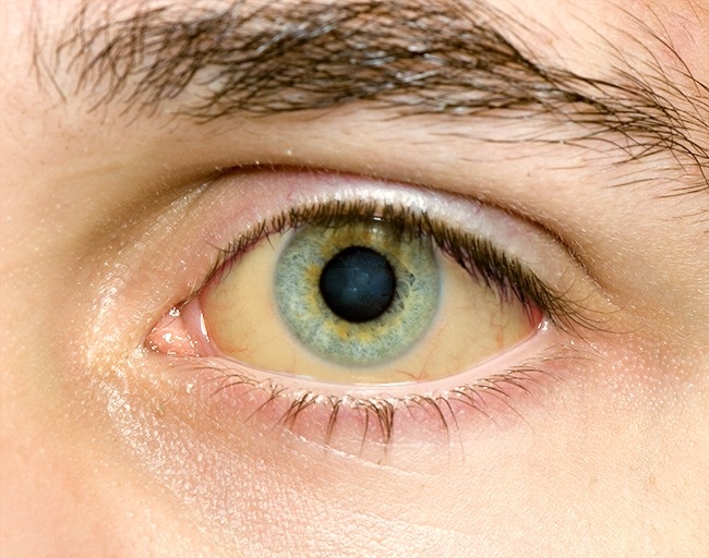 12 σημάδια που εμφανίζουν τα μάτια μας όταν έχουμε πρόβλημα με την υγεία μας - Εικόνα 12