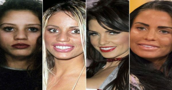 8 celebrities που σίγουρα μετάνιωσαν την πλαστική τους επέμβαση